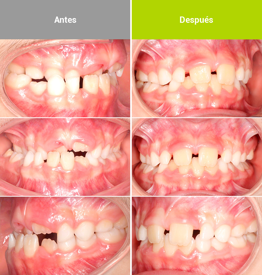 Mordida cruzada tratada con expansión rápida del maxilar